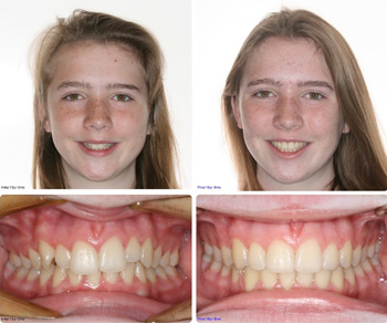 BeforeAfter_Patient5